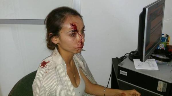 The brutal assault left Karla Silva in hospital with cerebral edema and problems with her vision.